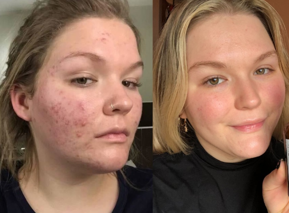  #47skin - after struggling with acne for years